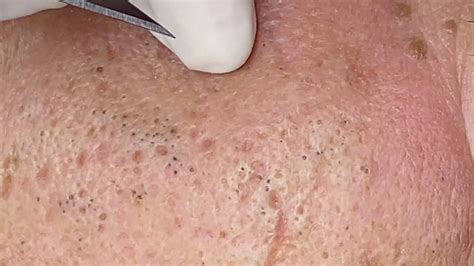 Massive Deep <b>Blackhead</b> is Hard To Remove Posted on July 24, 2020 November 10, 2020 Author Recail Posted in <b>Blackheads</b> <b>Removal</b> • Tagged big deep <b>blackheads</b>, deep <b>blackhead</b> for years , deep <b>blackhead</b> <b>removal</b> videos 2019 , deep <b>blackheads</b> on back. . Elderly blackhead removal